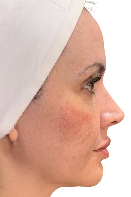 Dermal filler facial balancing after 2