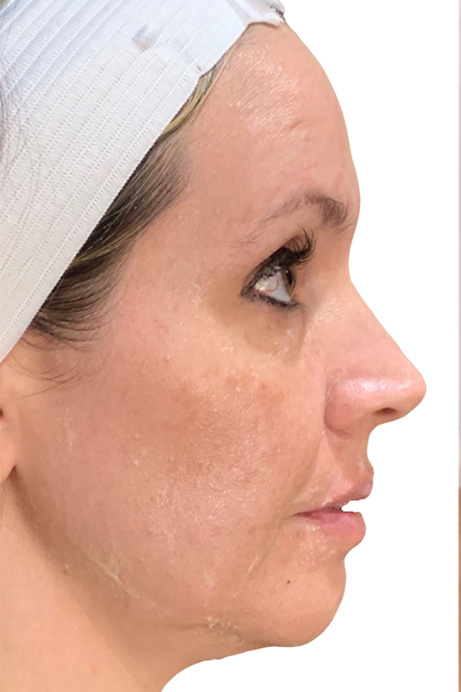 Dermal filler facial balancing before 2