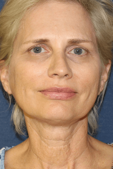 55-65 year old female facelift browlift blepharoplasty rhinoplasty before