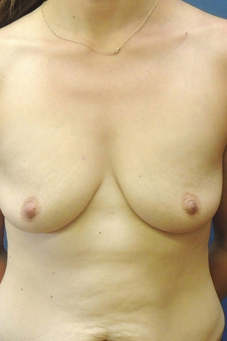 35-year-old female Bilateral Crescent Mastopexy; Bilateral Breast Augmentation
