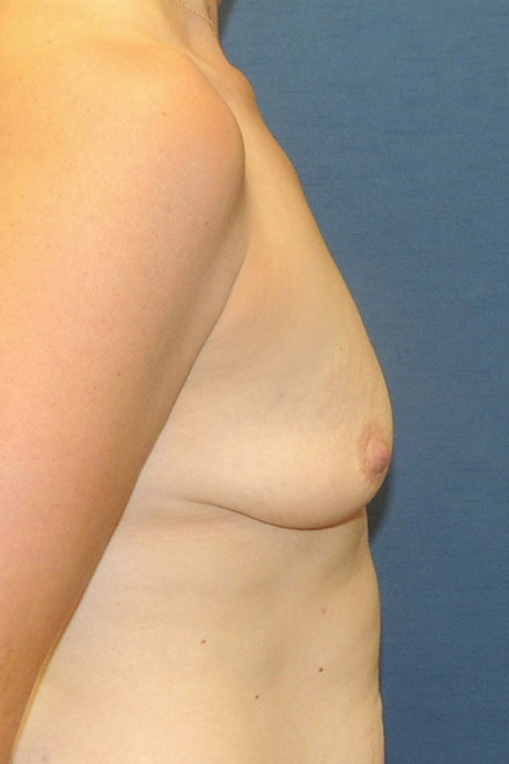 35-year-old female Bilateral Crescent Mastopexy; Bilateral Breast Augmentation