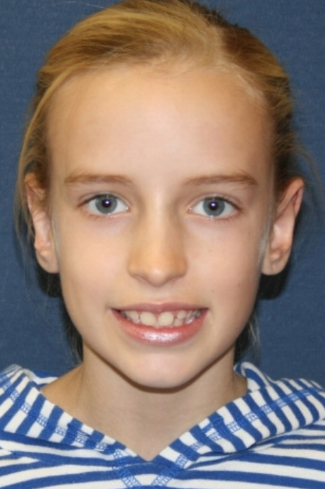 9 year old female otoplasty