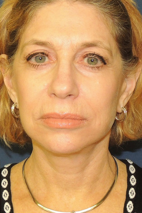 55-65 year old female facelift necklift blepharoplasty laser after