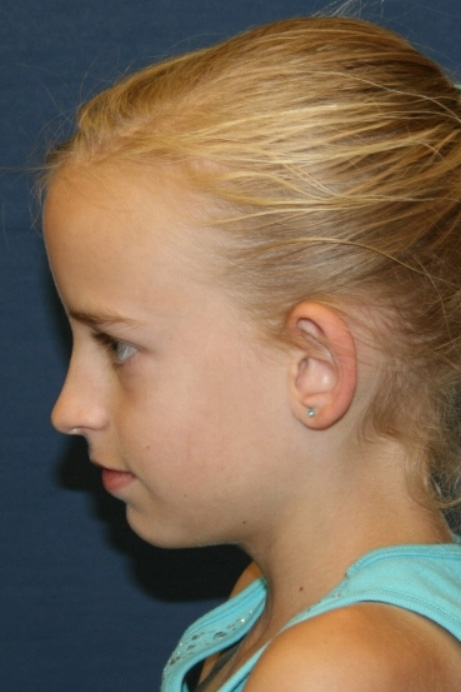 9 year old female otoplasty