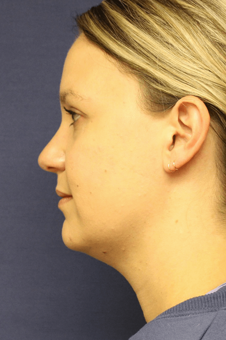 Female 30-40 years old face liposuction before