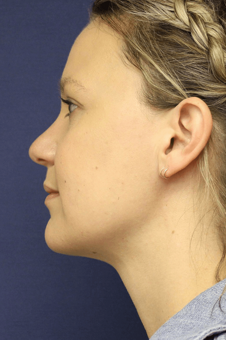 Female 30-40 years old face liposuction after