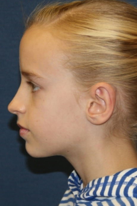9 year old female otoplasty
