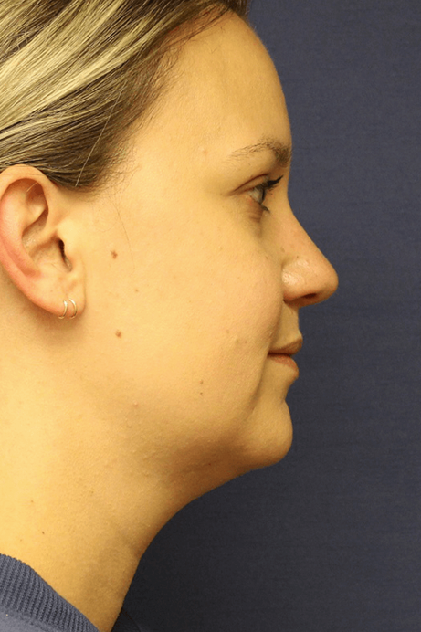 Female 30-40 years old face liposuction before