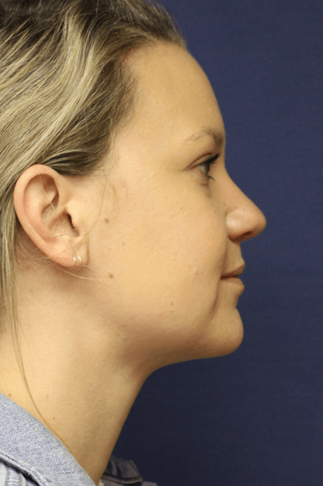 Female 30-40 years old face liposuction after