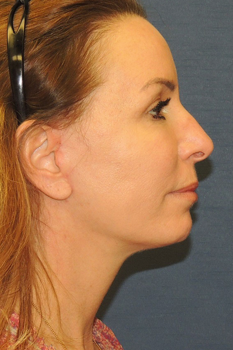 52 year old female mini facelift after