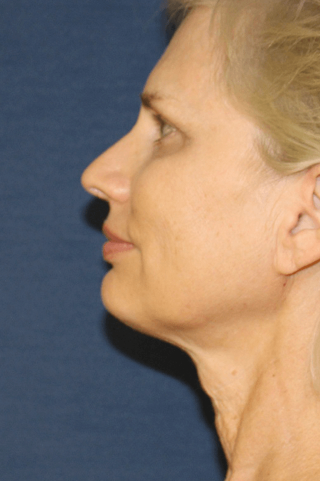 55-65 year old female facelift browlift blepharoplasty rhinoplasty before