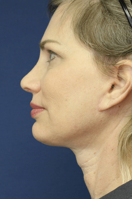 55-65 year old female facelift browlift blepharoplasty rhinoplasty after