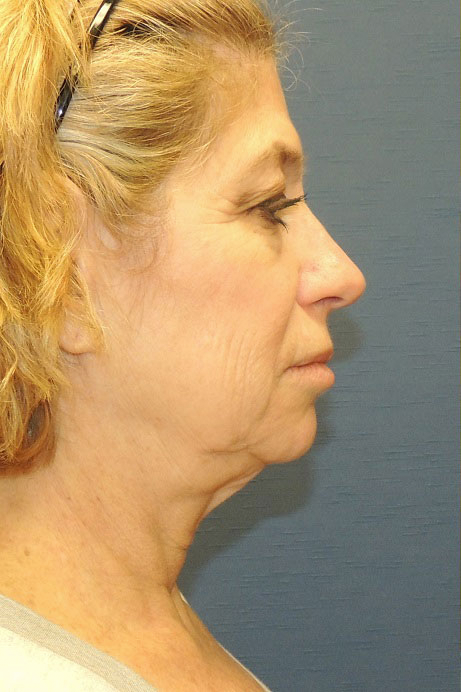 55-65 year old female facelift necklift blepharoplasty laser before