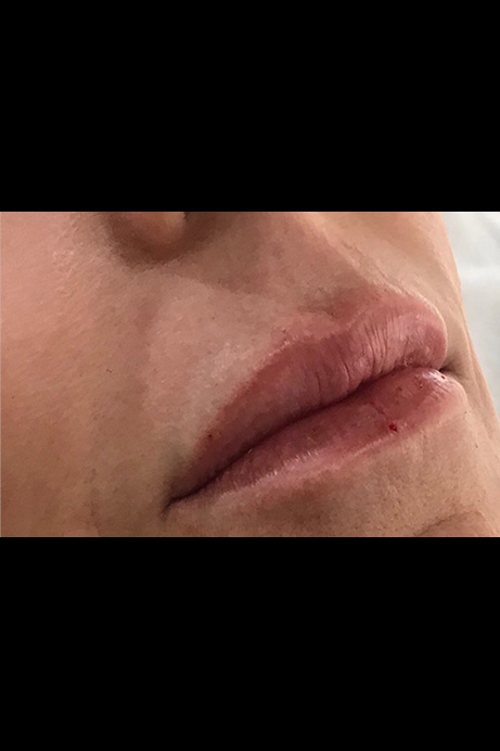 Dermal filler lips after