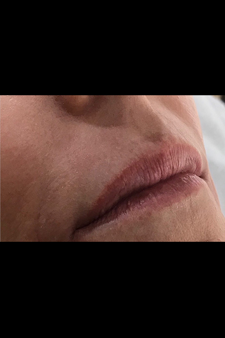 Dermal filler lips before