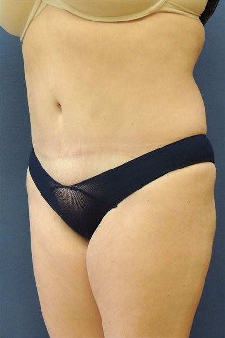 42 year old female abdominoplasty liposuction angle after photo