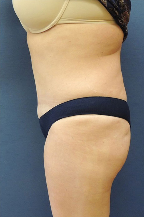 42 year old female abdominoplasty liposuction side after photo