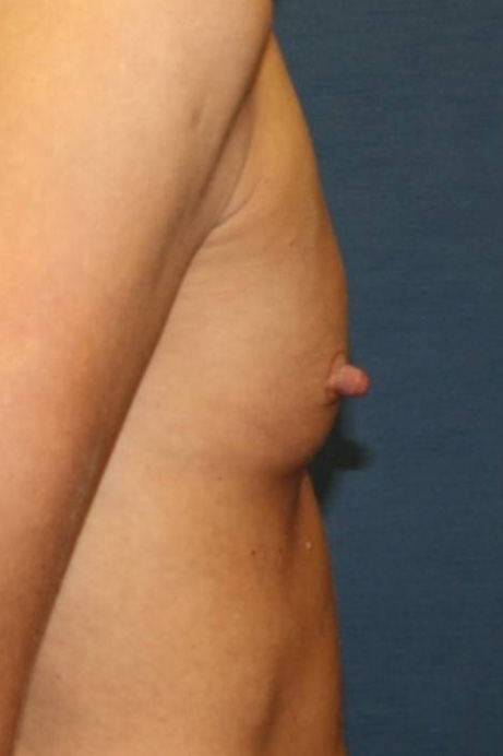 47-year-old female breast augmentation