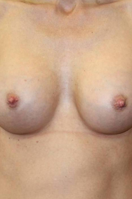 47-year-old female breast augmentation