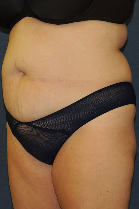 42 year old female abdominoplasty liposuction angle before photo