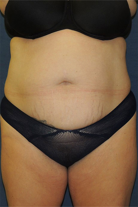 42 year old female abdominoplasty liposuction front before photo