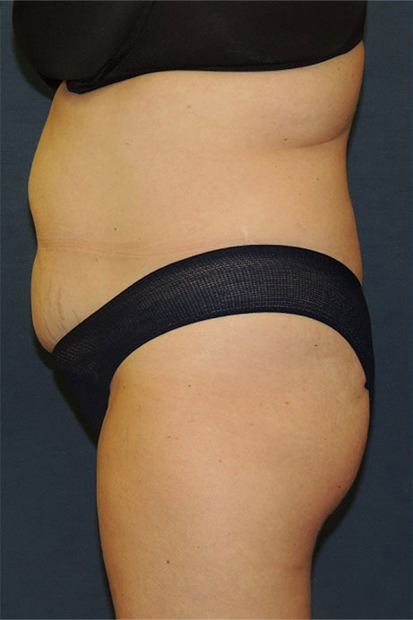 42 year old female abdominoplasty liposuction side before photo