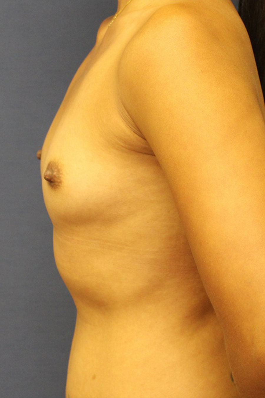  Breast Augmentation Female