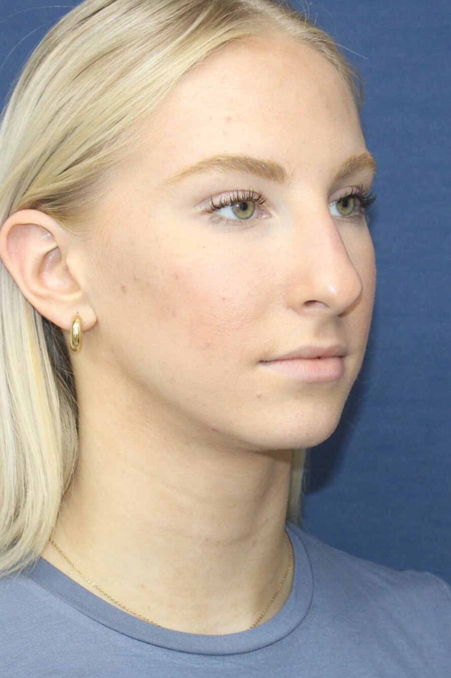 Patient Rhinoplasty RH2 - Before