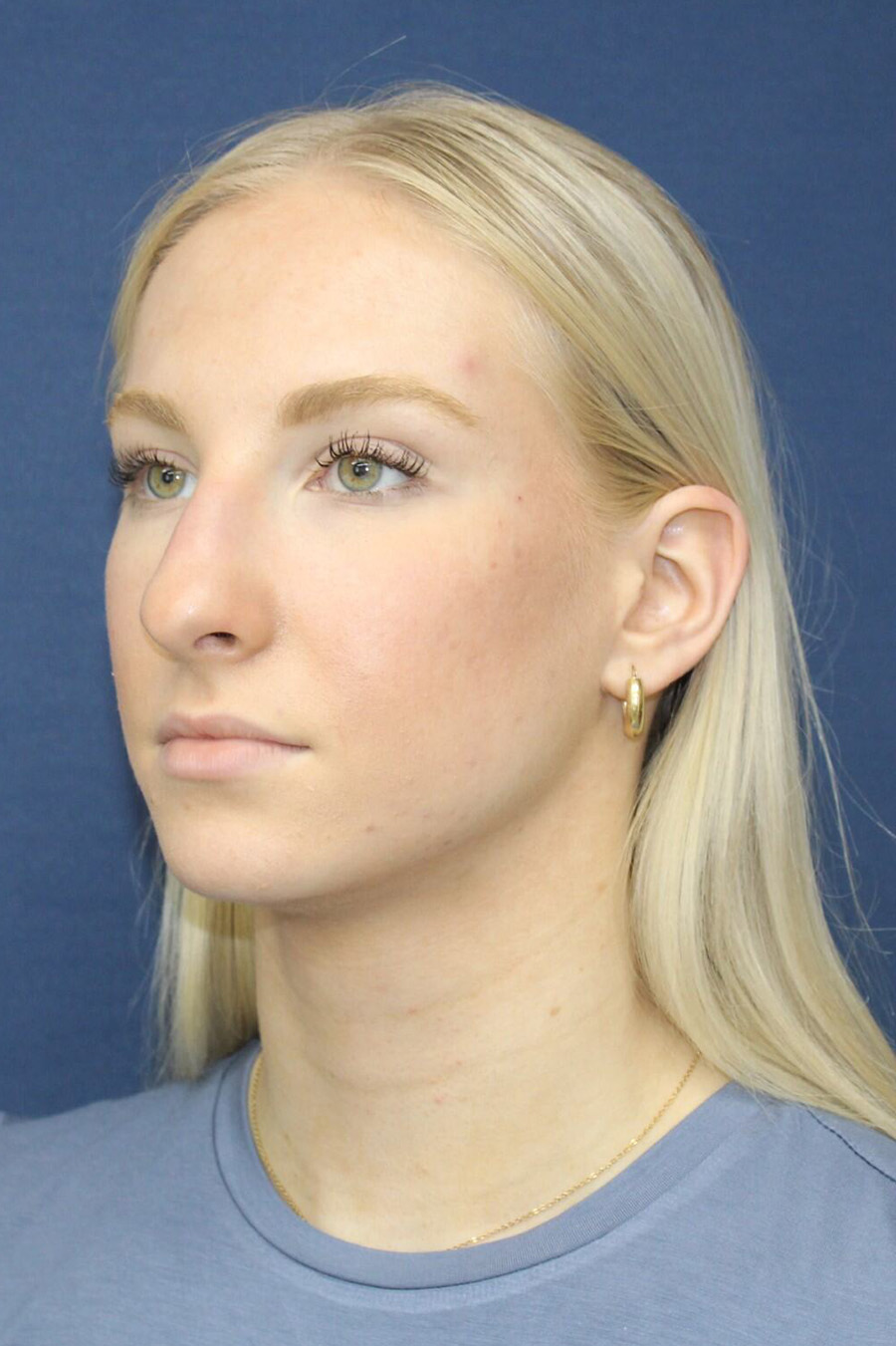 Patient Rhinoplasty RH2 - Before