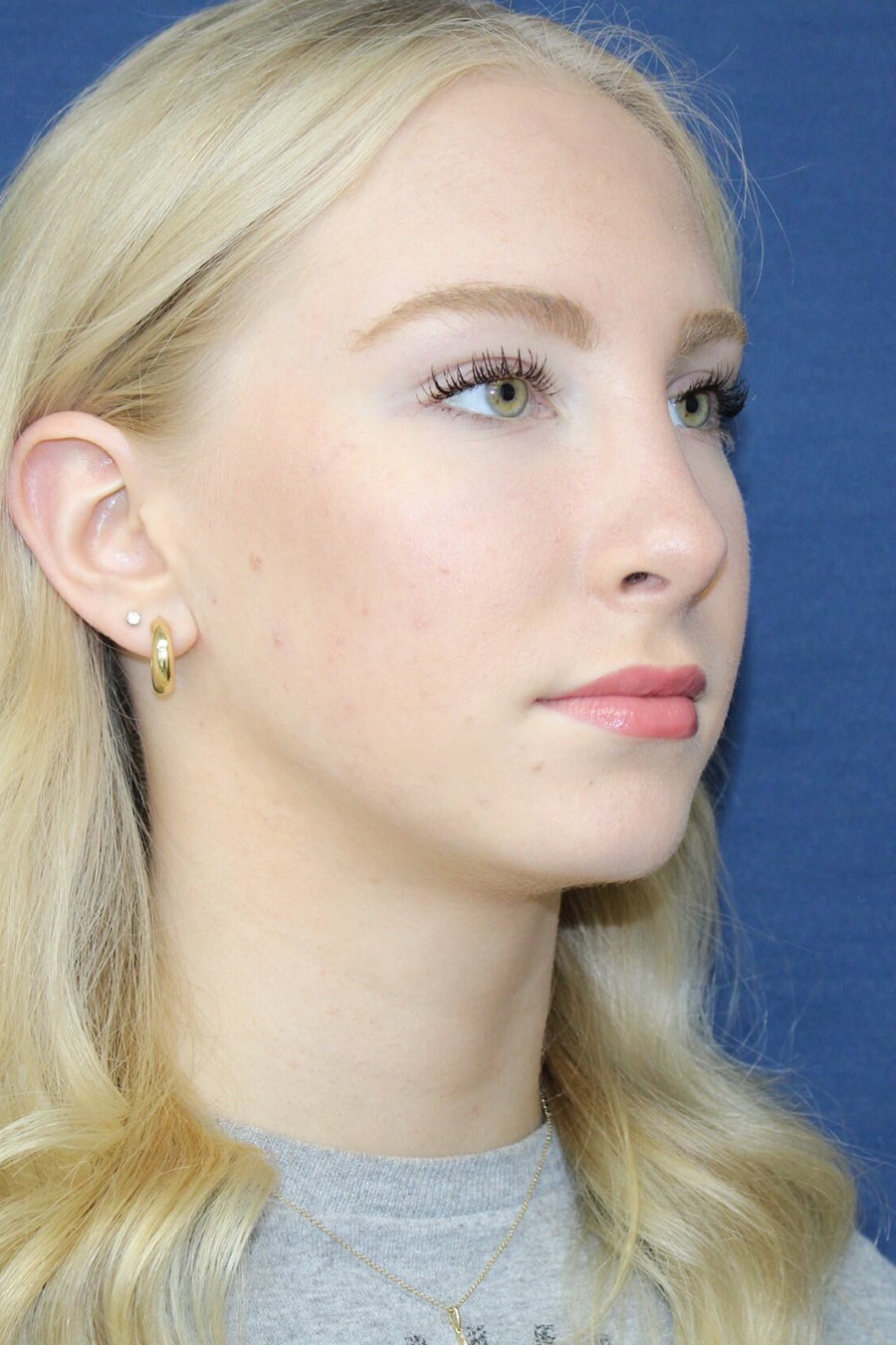 Patient Rhinoplasty RH2 - After