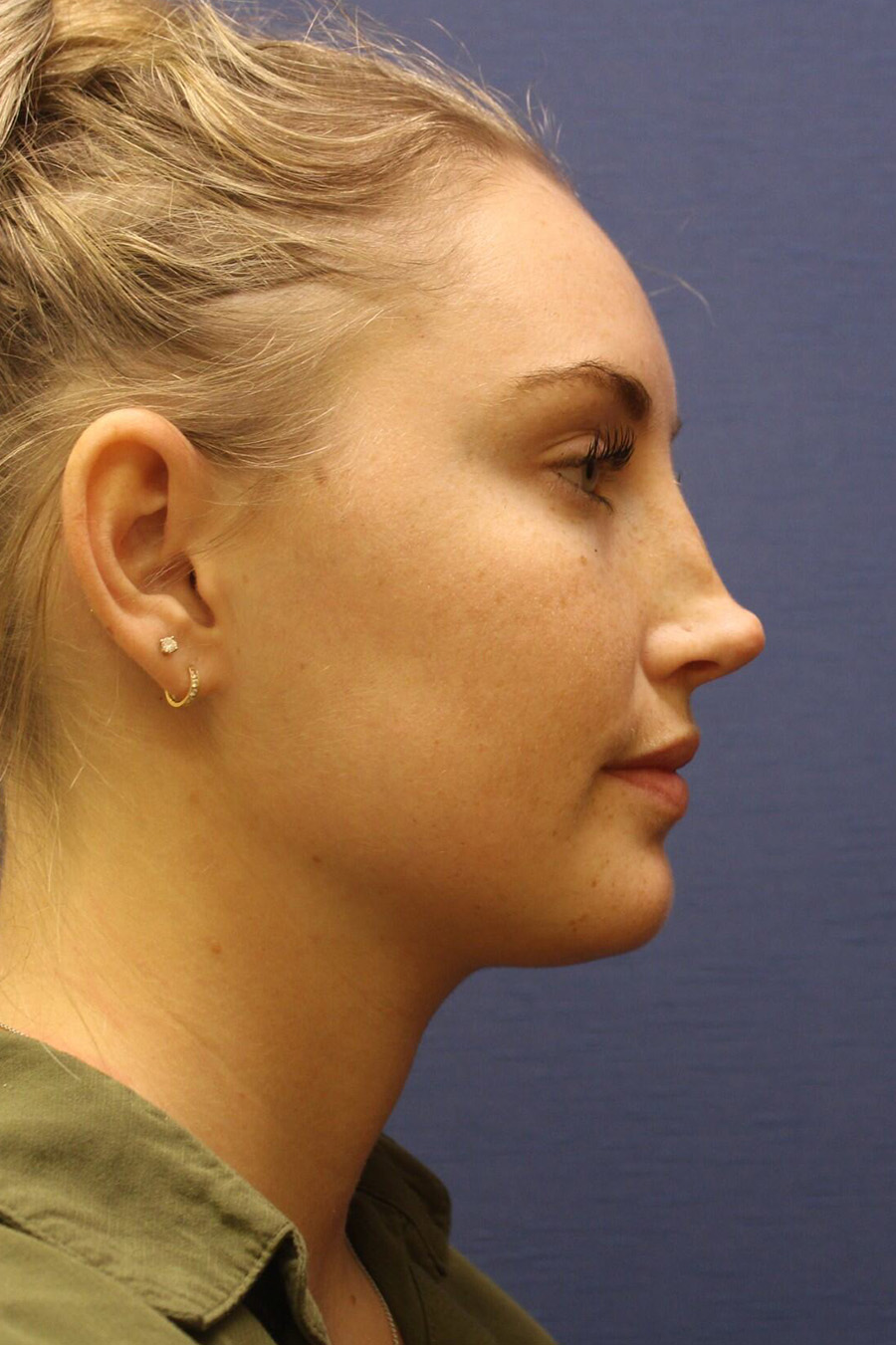 Rhinoplasty Revision Before