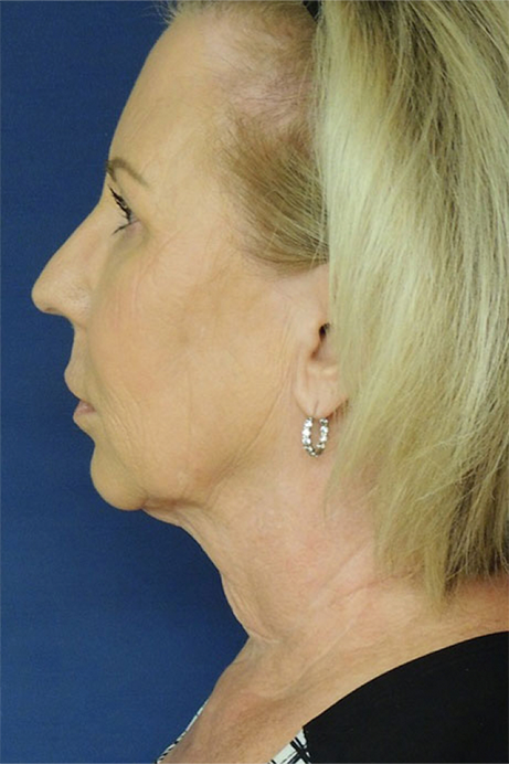 female-55-65-bleph-facelift-necklift-laser-rf-before-side-1