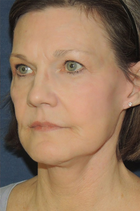 female brow lift after