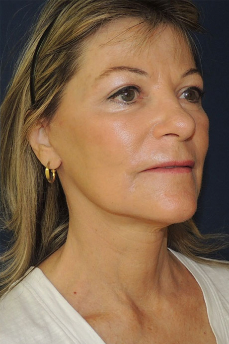 female-60-70 -2-bleph-facelift-erbium-after-angle-1