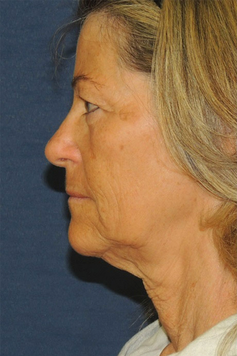 female-60-70 -2-bleph-facelift-erbium-before-side-2