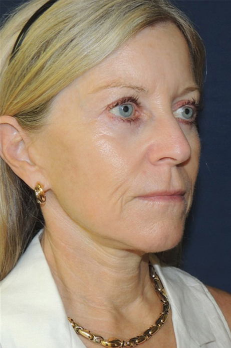 female-60-70-bleph-facelift-erbium-after-angle-1
