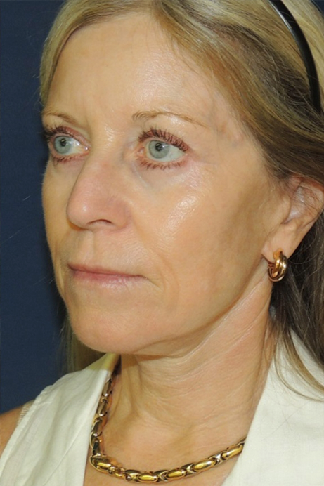 female-60-70-bleph-facelift-erbium-after-angle-2