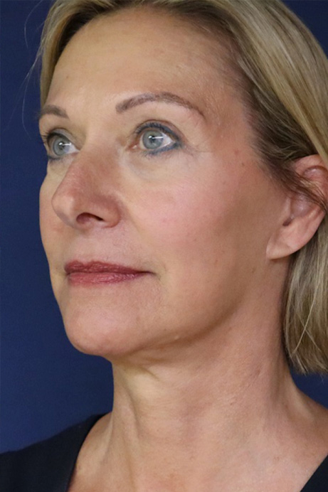female brow lift facelift blepharoplasty after