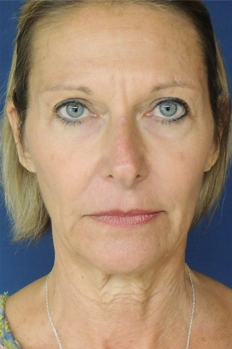 female brow lift facelift blepharoplasty before