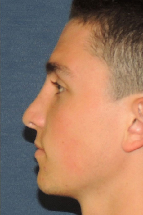 male-18-rhinoplasty-after-side-2