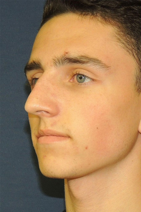 male-18-rhinoplasty-before-angle-1