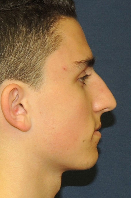 male-18-rhinoplasty-before-side-1