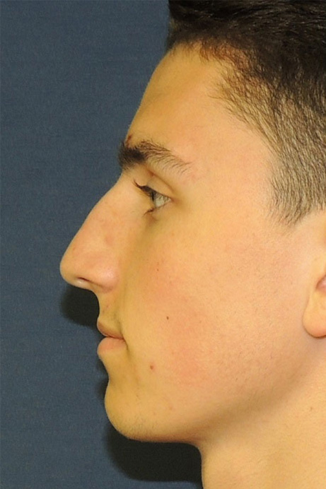 male-18-rhinoplasty-before-side-2