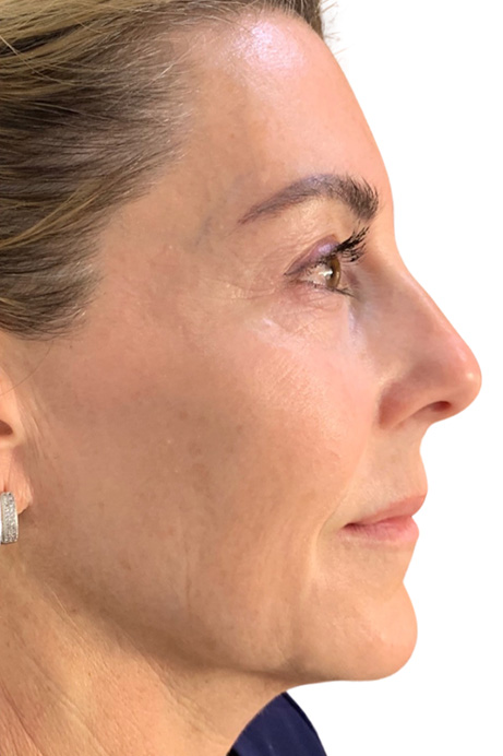 Dermal filler facial balancing after 3