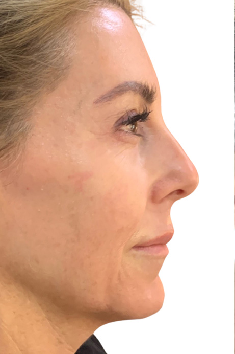 Dermal filler facial balancing before 3