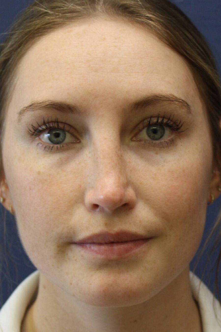 Rhinoplasty Revision After