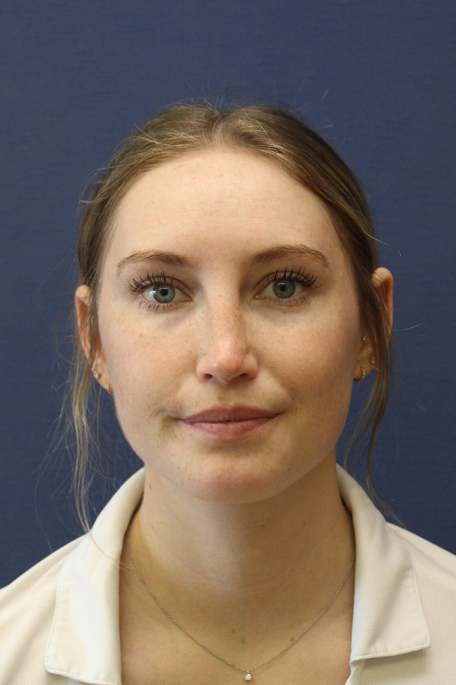 Rhinoplasty Revision After