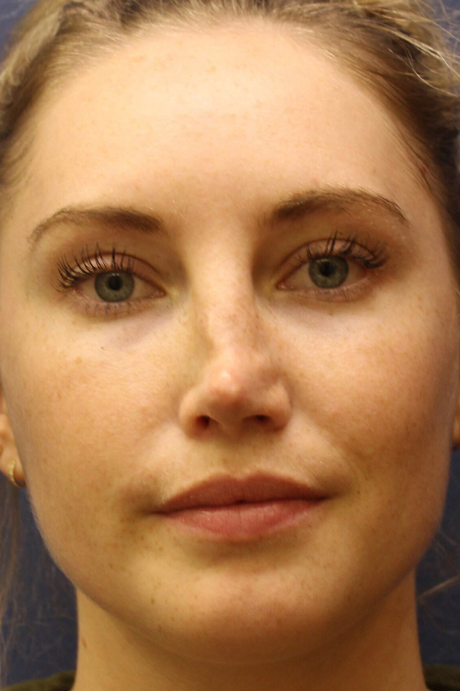 Rhinoplasty Revision Before