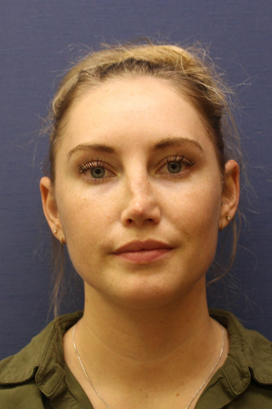 Rhinoplasty Revision Before