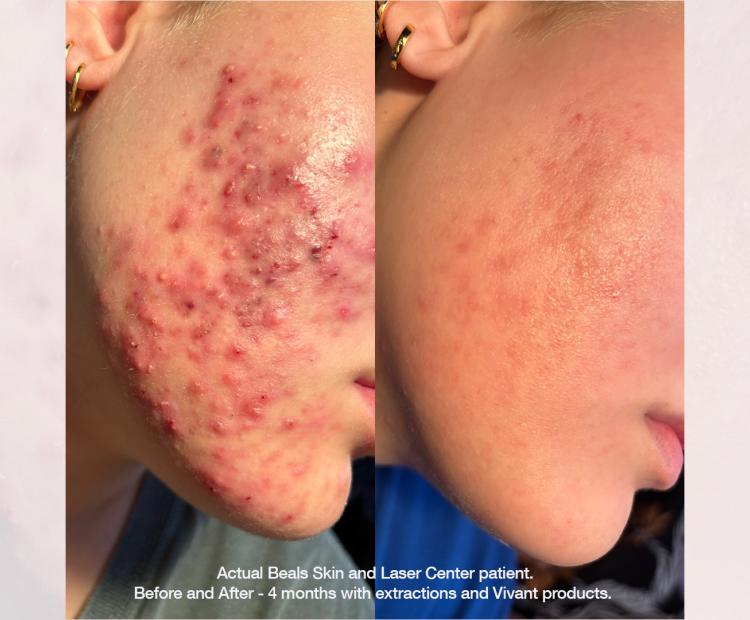 Aestheticians and Acne